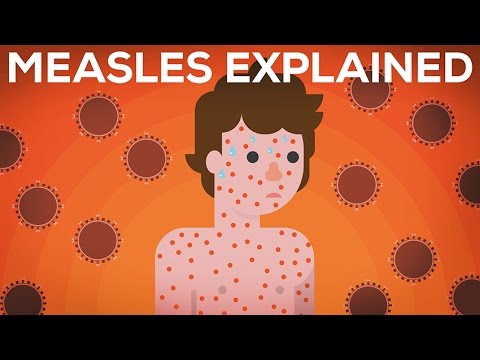 Measles Explained — Vaccinate or Not?